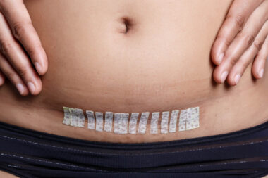 Ulcers on the skin in the abdomen after cutting off the thread.