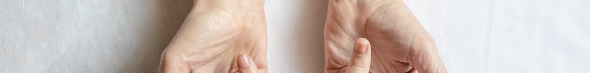 Hands of a woman with twisted fingers. Dupuytren’s contracture disease.