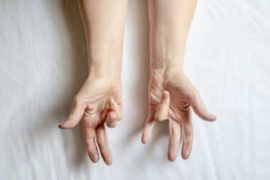 Hands of a woman with twisted fingers. Dupuytren’s contracture disease.